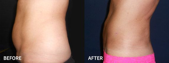 liposuction before and after