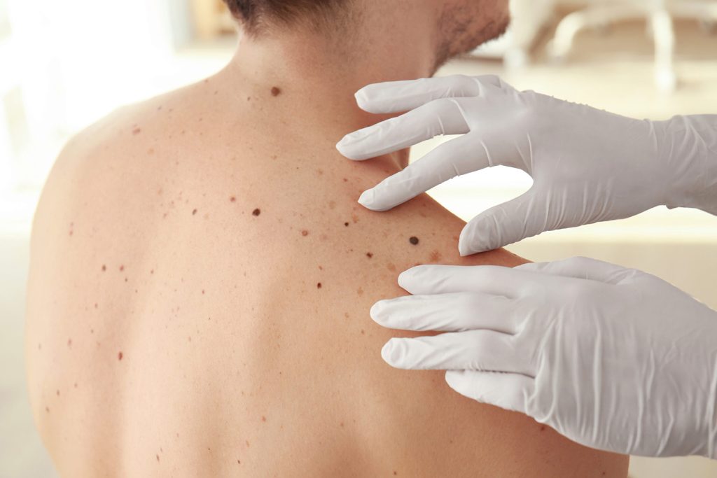 Skin Cancer Screening New York