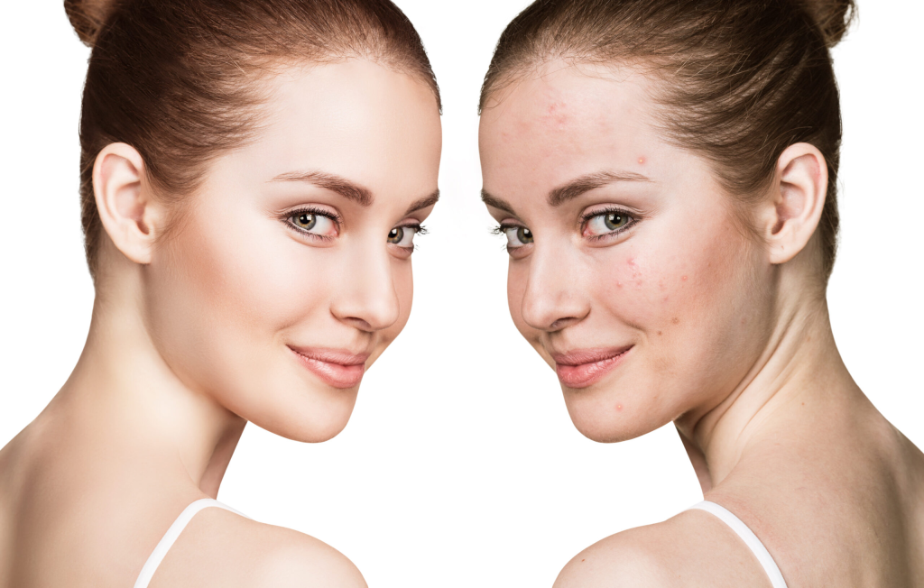 Acne Treatment New York