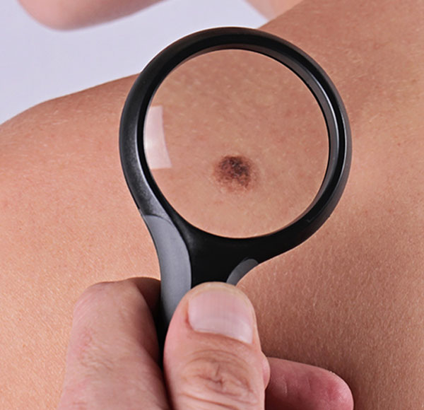 Skin Tag Removal New York