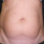 Liposuction Before & After Patient #20105