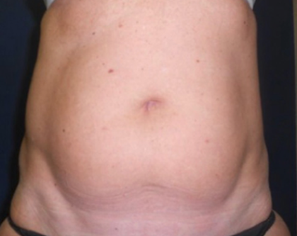 Liposuction Before & After Patient #20105