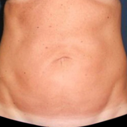 Liposuction Before & After Patient #20105