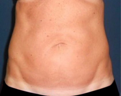 Liposuction Before & After Patient #20105