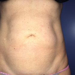 Liposuction Before & After Patient #20106