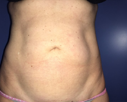 Liposuction Before & After Patient #20106