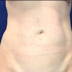 Liposuction Before & After Patient #20106