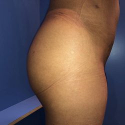 Brazilian Butt Lift Before & After Patient #19105