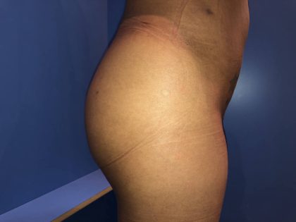 Brazilian Butt Lift Before & After Patient #19105