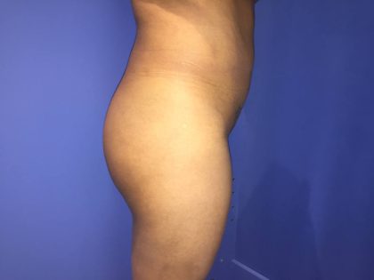 Brazilian Butt Lift Before & After Patient #19105