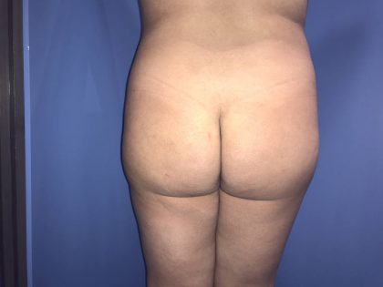 Brazilian Butt Lift Before & After Patient #19106
