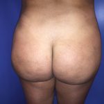 Brazilian Butt Lift Before & After Patient #19106