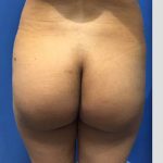 Brazilian Butt Lift Before & After Patient #19107