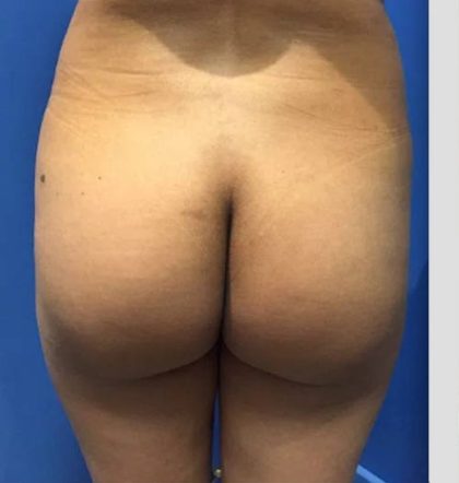 Brazilian Butt Lift Before & After Patient #19107