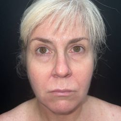 Facelift Before & After Patient #19148