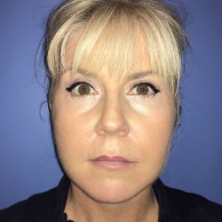 Facelift Before & After Patient #19148