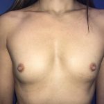 Breast Augmentation Before & After Patient #19187