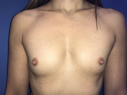 Breast Augmentation Before & After Patient #19187