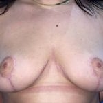 Breast Reduction Before & After Patient #19205