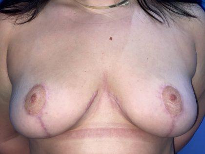 Breast Reduction Before & After Patient #19205
