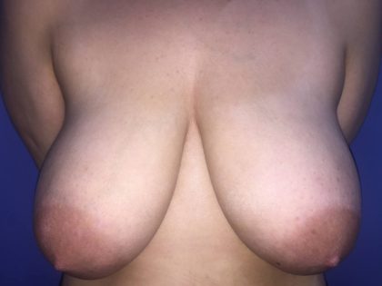 Breast Reduction Before & After Patient #19206