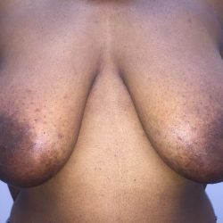 Breast Reduction Before & After Patient #19207