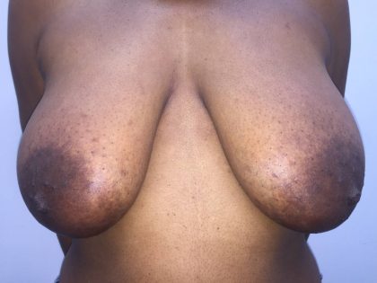 Breast Reduction Before & After Patient #19207