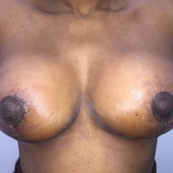 Breast Reduction Before & After Patient #19207