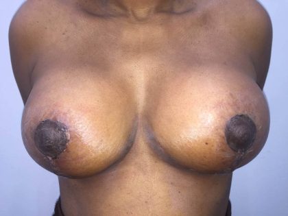 Breast Reduction Before & After Patient #19207