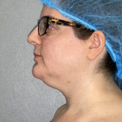 Chin Liposuction Before & After Patient #19228