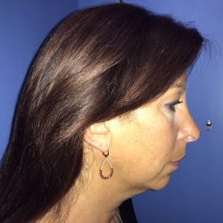 Chin Augmentation Before & After Patient #19229
