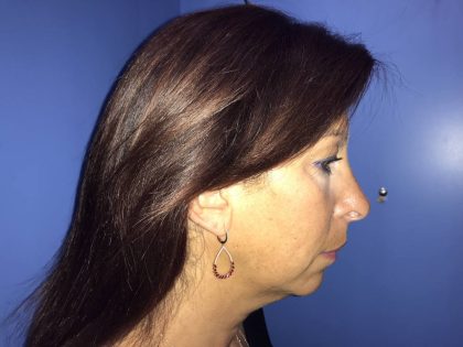 Chin Augmentation Before & After Patient #19229