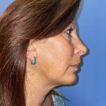 Chin Augmentation Before & After Patient #19229