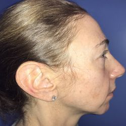 Chin Augmentation Before & After Patient #19230