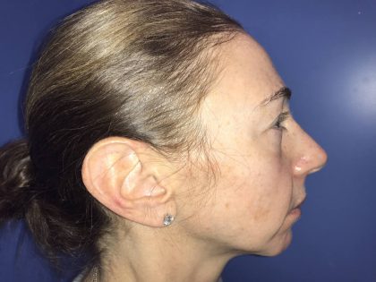 Chin Augmentation Before & After Patient #19230