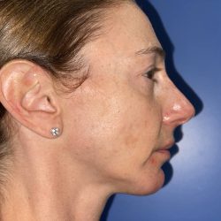 Chin Augmentation Before & After Patient #19230