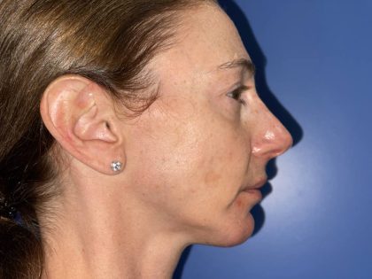 Chin Augmentation Before & After Patient #19230