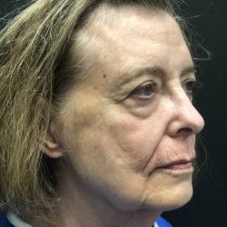Facelift Before & After Patient #19580