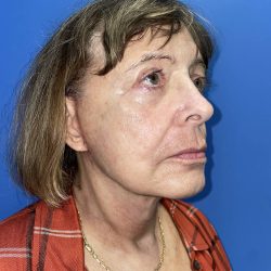 Facelift Before & After Patient #19580