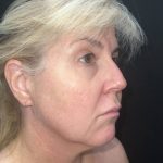 Facelift Before & After Patient #19148