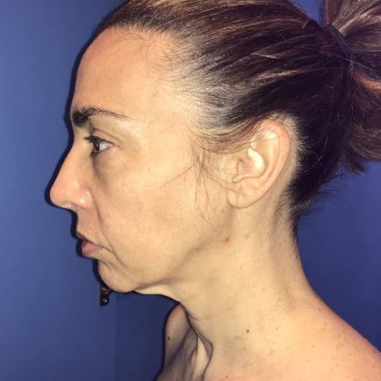 Facelift Before & After Patient #19587