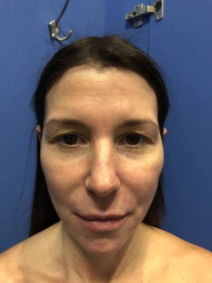 Facelift Before & After Patient #19359