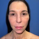 Facelift Before & After Patient #19359