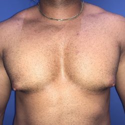 Gynecomastia Before & After Patient #19386