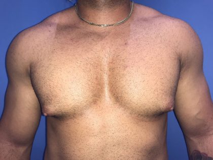 Gynecomastia Before & After Patient #19386