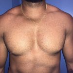Gynecomastia Before & After Patient #19386