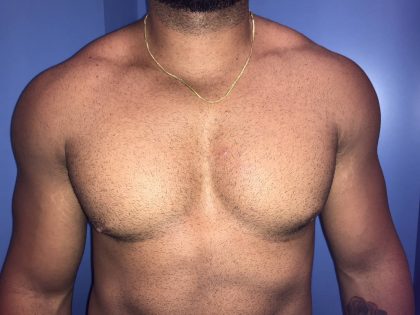 Gynecomastia Before & After Patient #19386