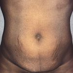 Tummy Tuck Before & After Patient #19363