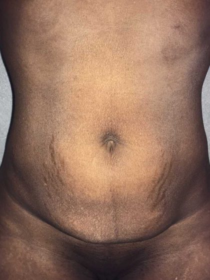 Tummy Tuck Before & After Patient #19363