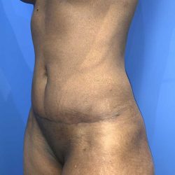 Tummy Tuck Before & After Patient #19363